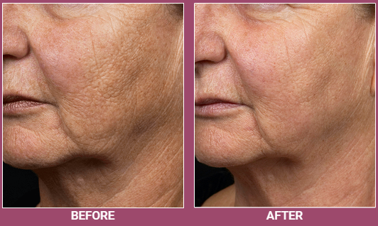 The result of wrinkle treatment after the Fraxel procedure
