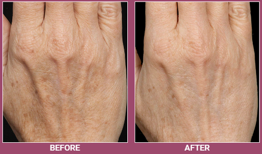 The result of the treatment of brown spots after the Fraxel procedure