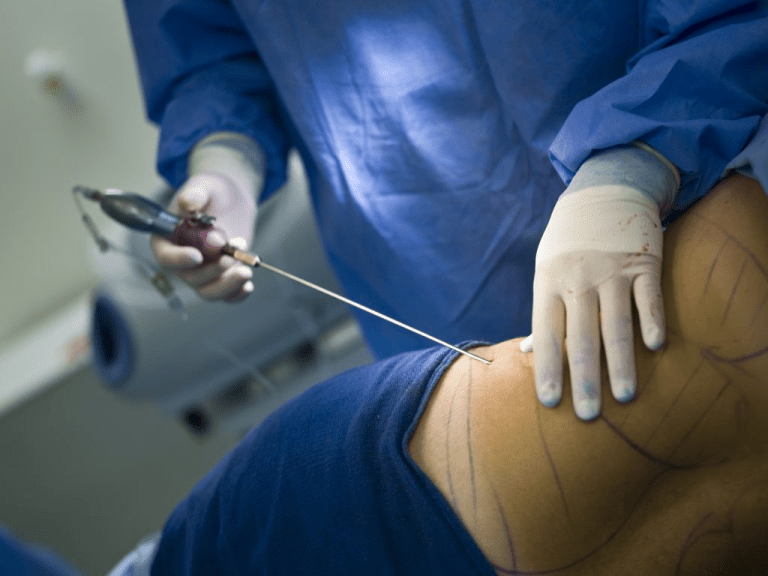 Tumescent liposuction