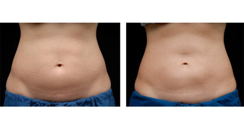 cryoskin-vs-coolsculpting