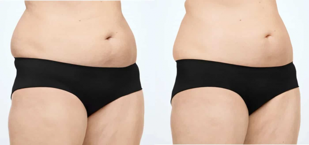 cryoskin-vs-coolsculpting