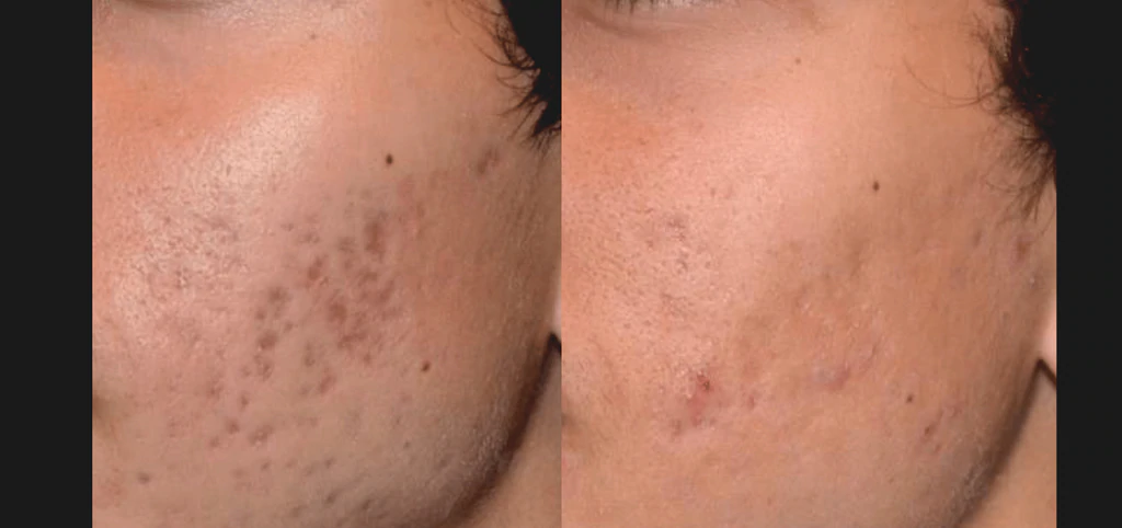  acne scars