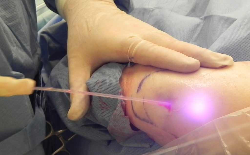Laser-assisted liposuction
