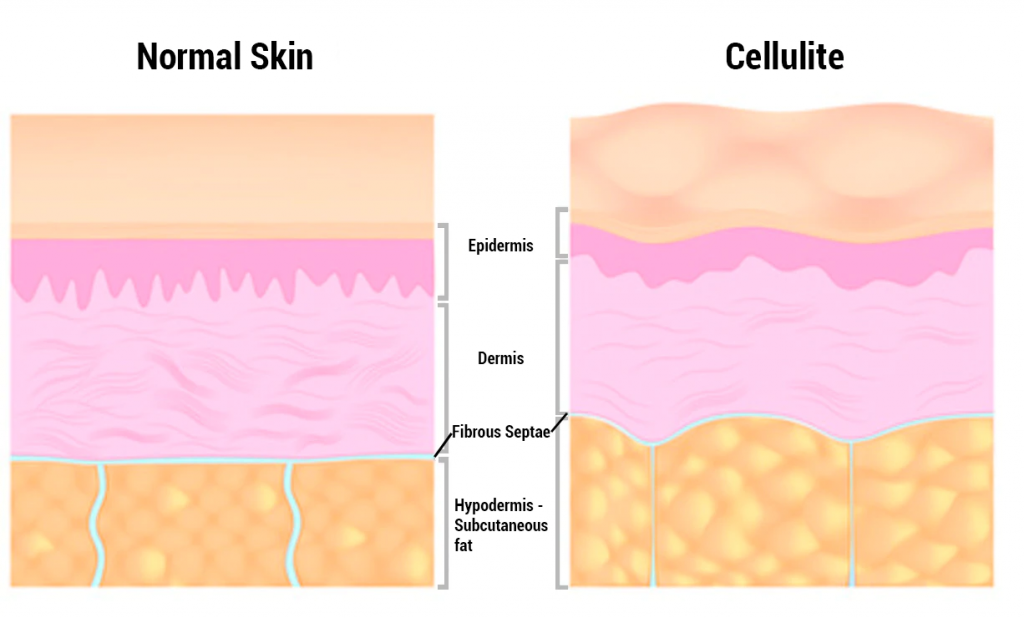 Comparison of what the skin structure looks like without cellulite and with it