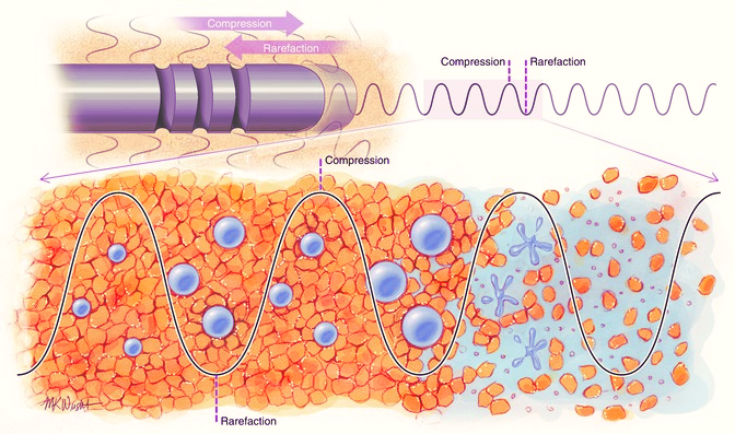 Ultrasound-assisted lipolysis (UAL)