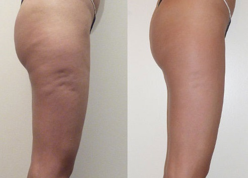 The appearance of cellulite before and after using infrared sauna blankets for about 3 months