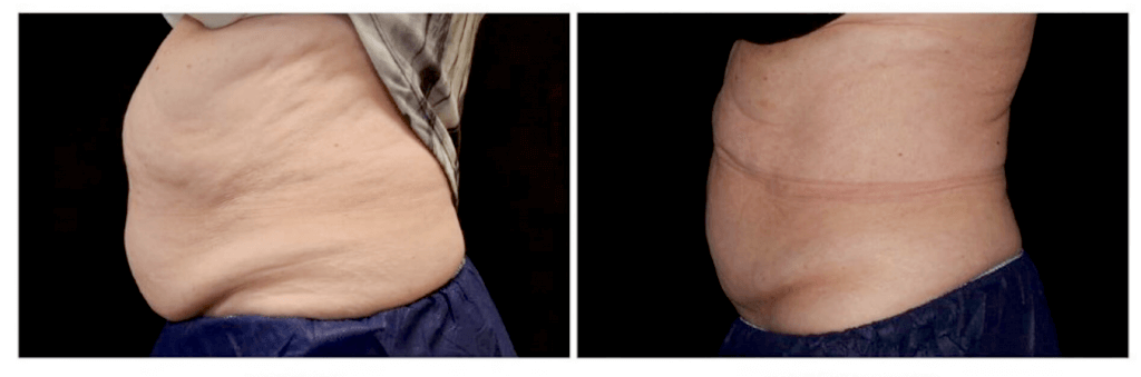 Before and after using Cryoskin machine for abdomen