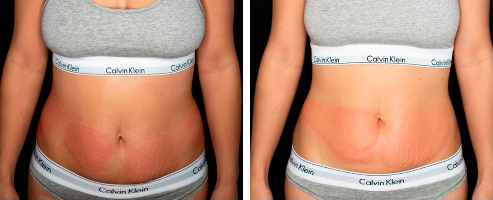 CryoSkin Slimming