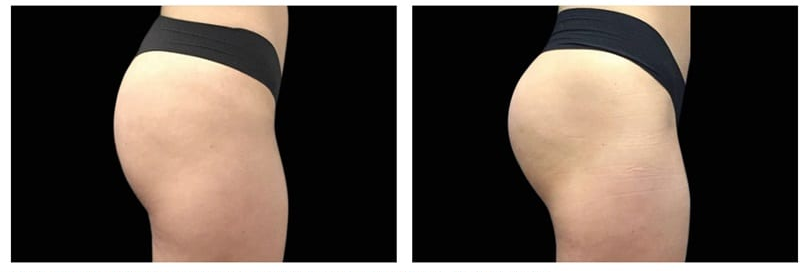 The result of using Emsculpt on the thighs