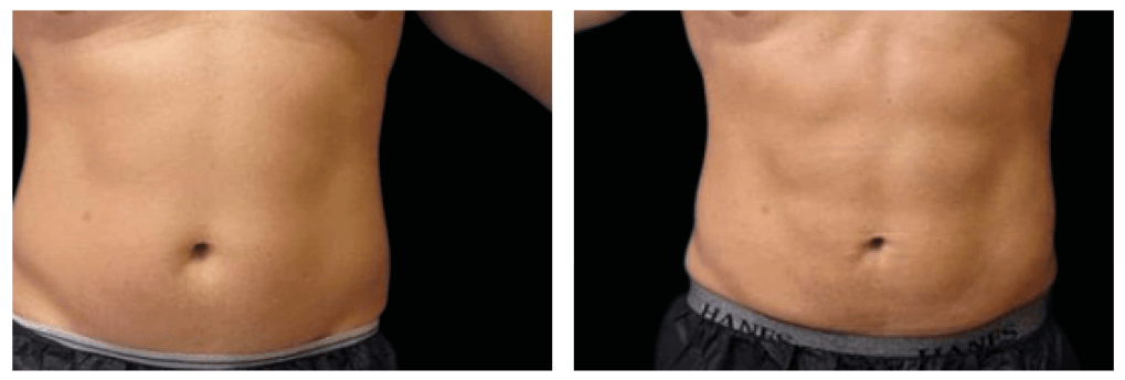 The result of using the Emsculpt device on the abdomen