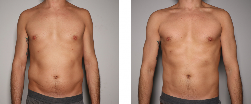 Cryo slimming results after 1 treatment
