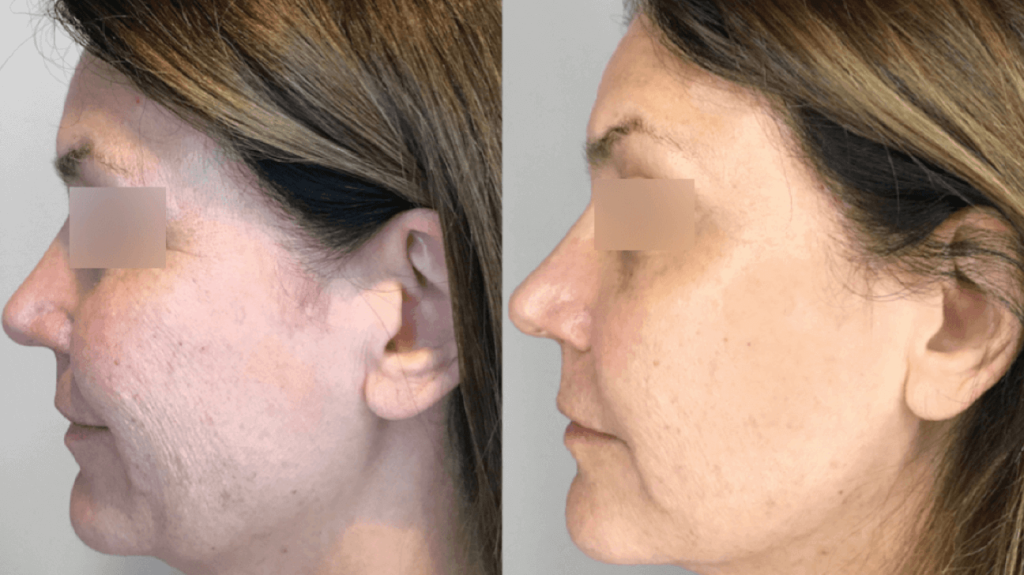 Cryo facial results after 2 treatments