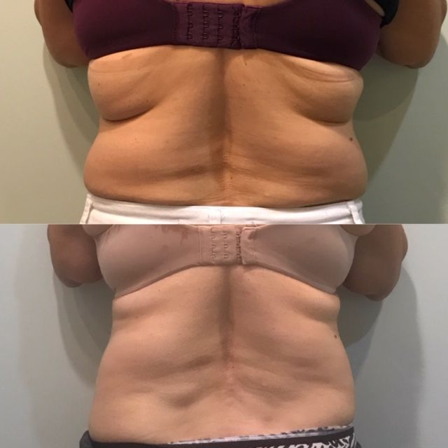 Cryo slimming results after 2 treatments