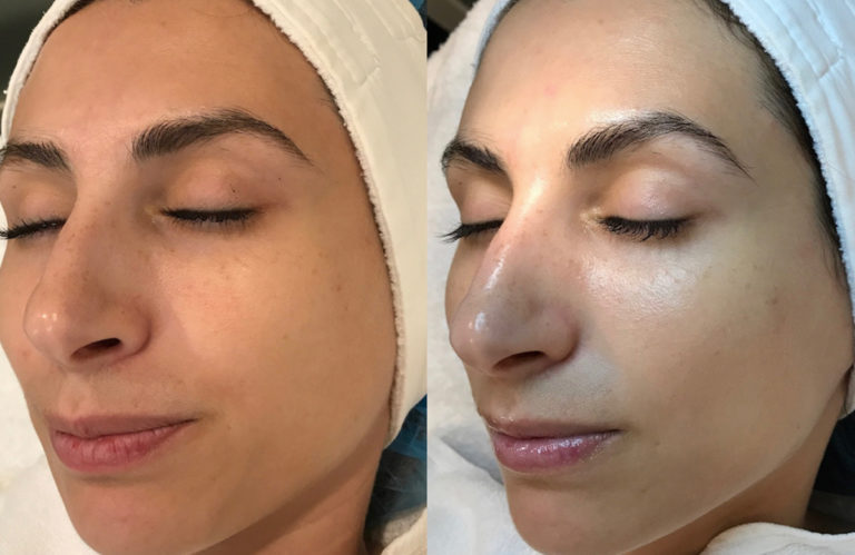 Cryo facial before & after 1 session