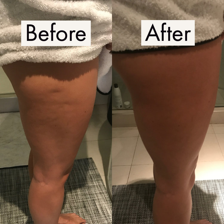 Cryo toning before & after 1 session