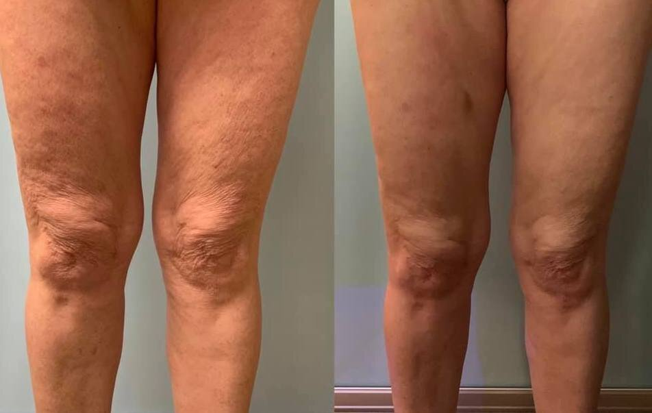 Cryo toning results after 5 treatments