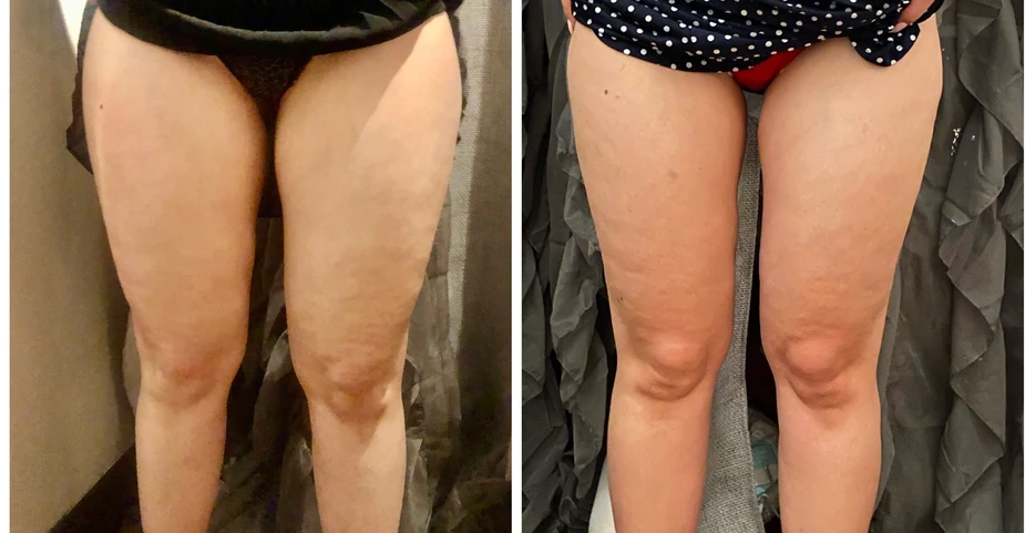 Cryo toning results after 4 sessions