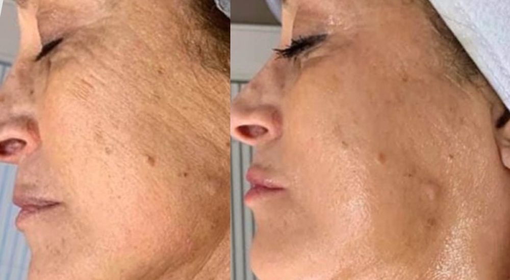 Cryo facial results after 5 sessions