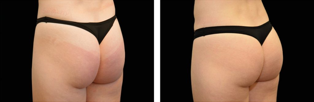 EmSculp Neo buttocks before and after