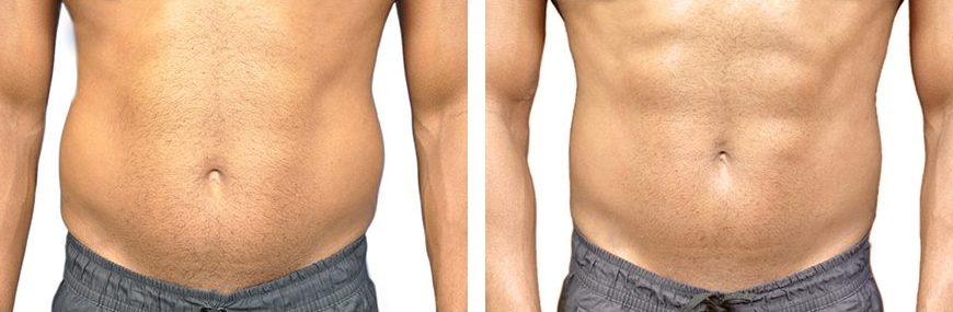 Does Emsculpt Really Work Before After Clinical Results 2023 