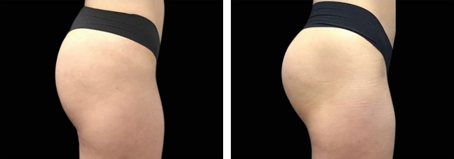 EmSculp buttocks before and after