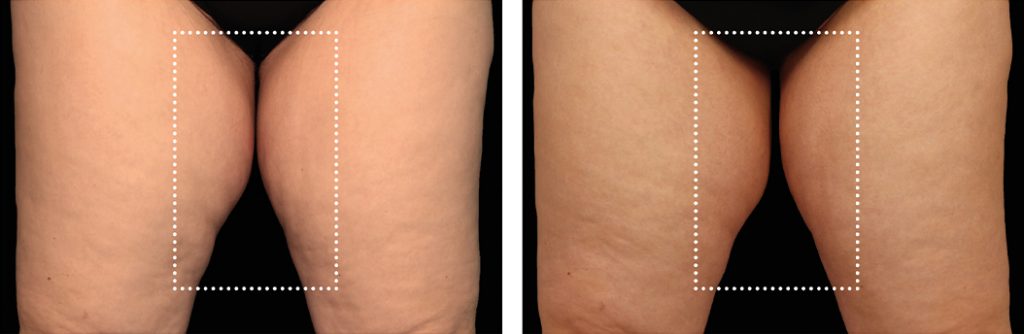 EmSculp Neo for inner thighs before and after
