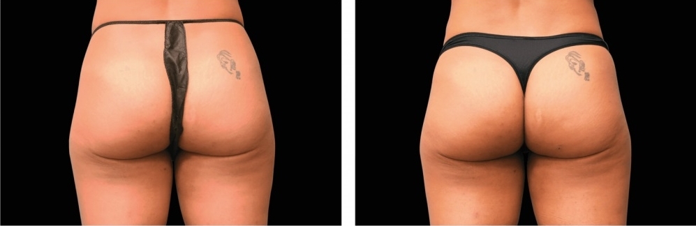  EmSculp Neo buttocks before and after