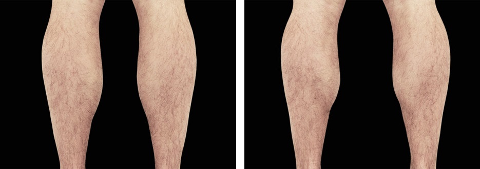 EmSculpt men calves before and after