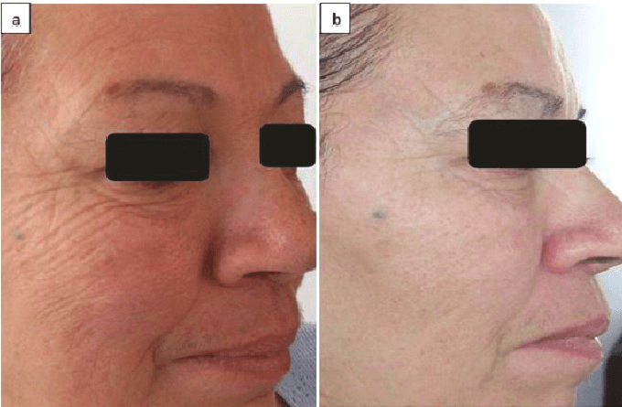 Before and after results on 63-year-old patients after cold laser therapy