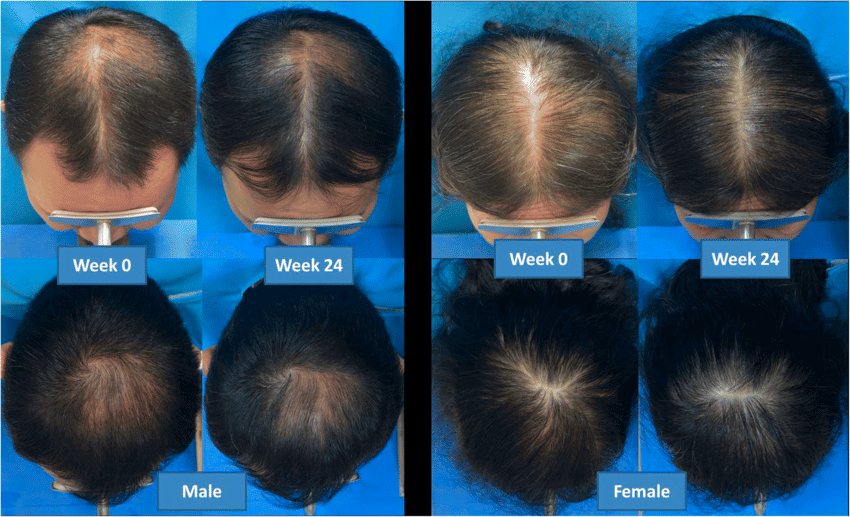 Before and after cold laser therapy with a special helmet.