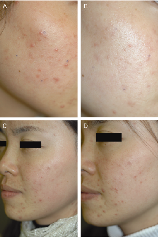 Before and after cold laser therapy for treating acne. 