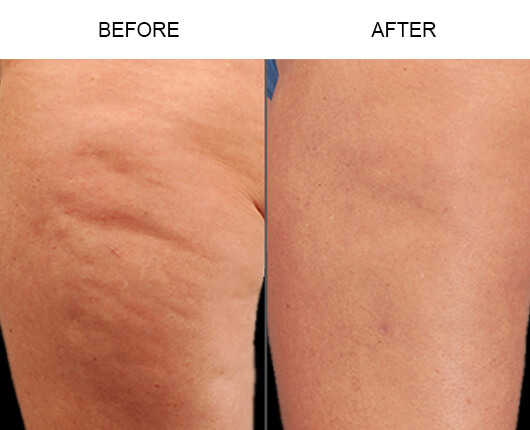 The result of using a vibrosculpt for cellulite treatment