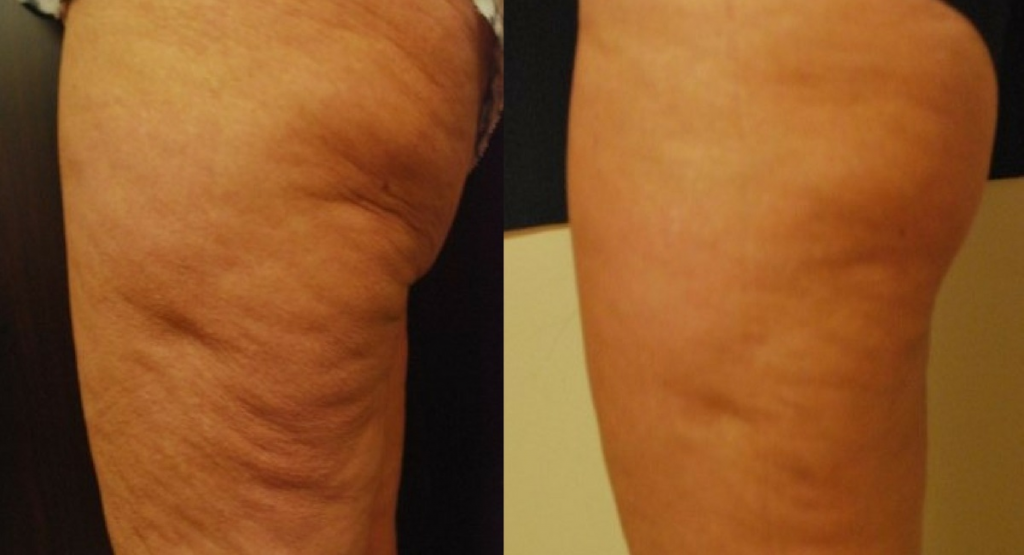 The result of using the vibrosculpt device on the thighs