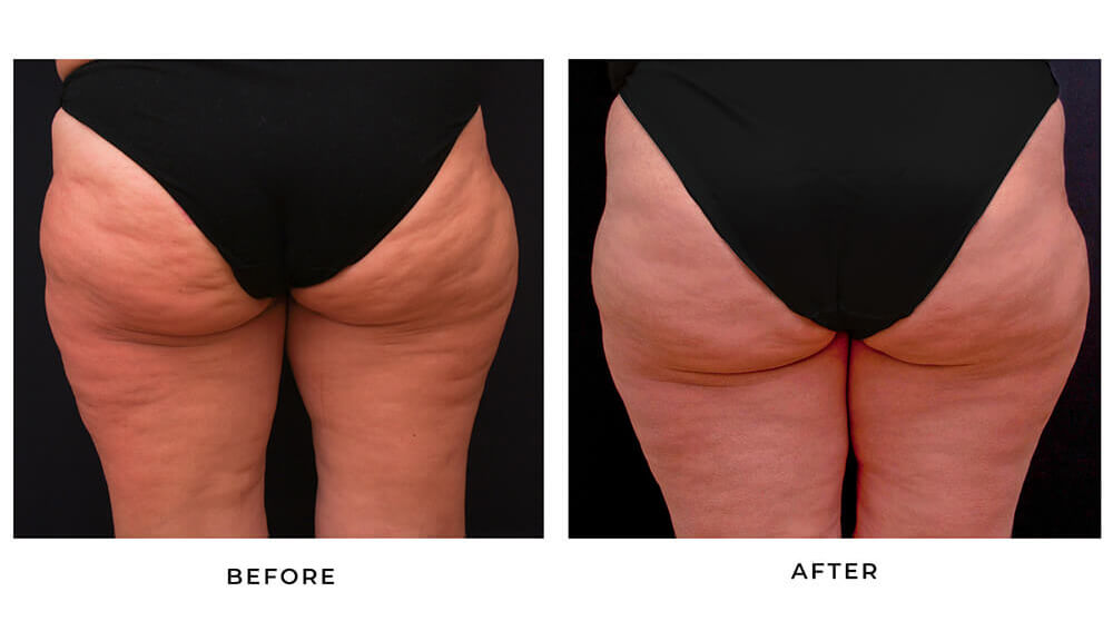 The result of using the vibrosculpt device on the buttocks