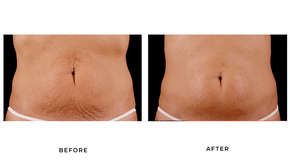 The result of using a vibrosculpt for cellulite treatment