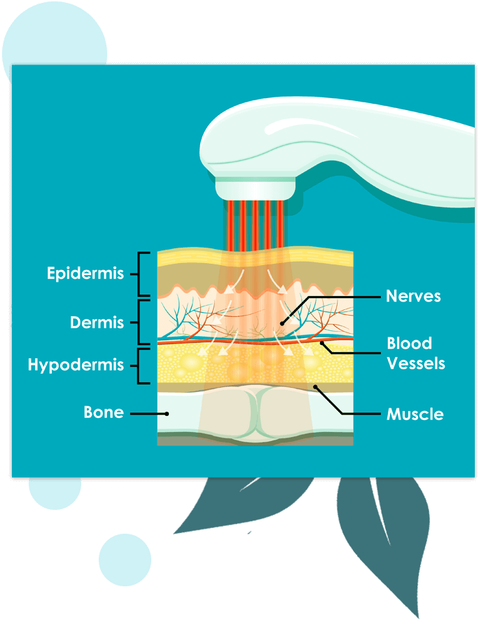 Laser impact on skin layers