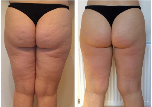 The result of using LLLT to reduce cellulite