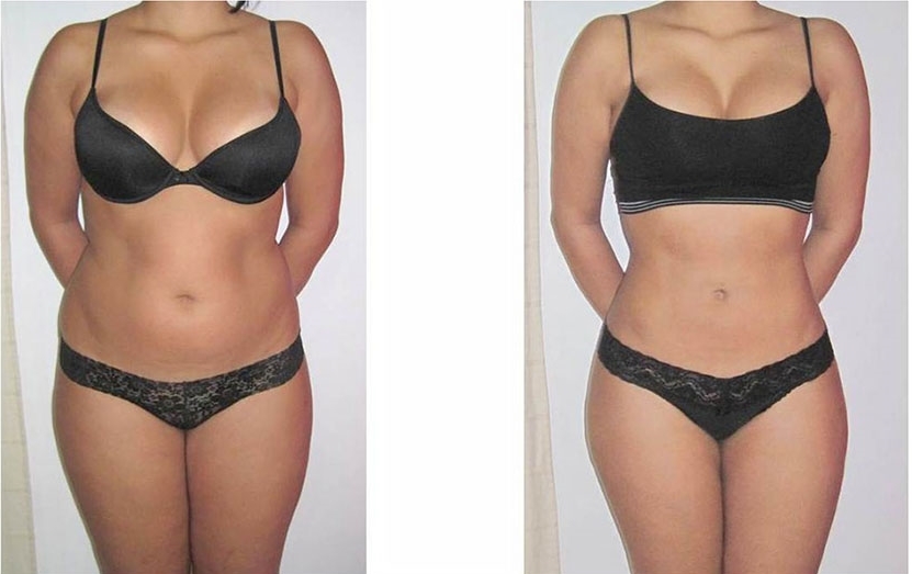 Laser Lipo Before & After
