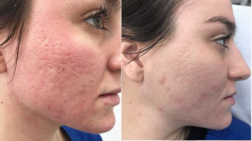 Effectiveness of acne treatment with cold laser therapy