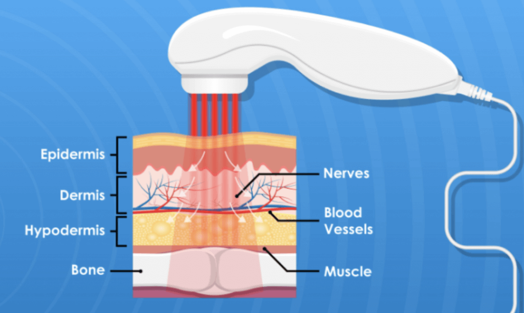 Cold laser therapy interaction with different layers of the skin