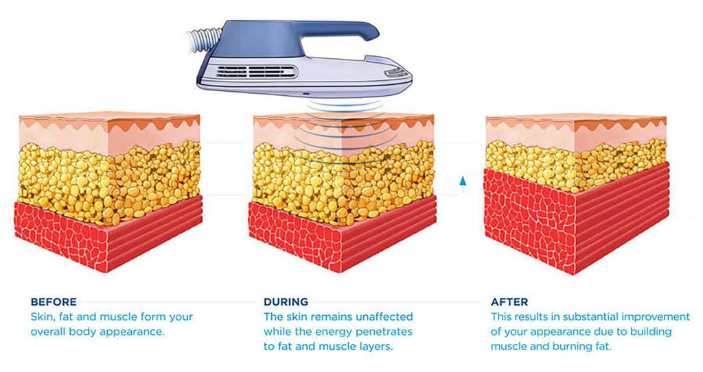 How Emsculpt Neo works 