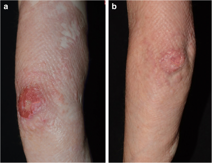 Effectiveness of wounds treated with cold laser therapy