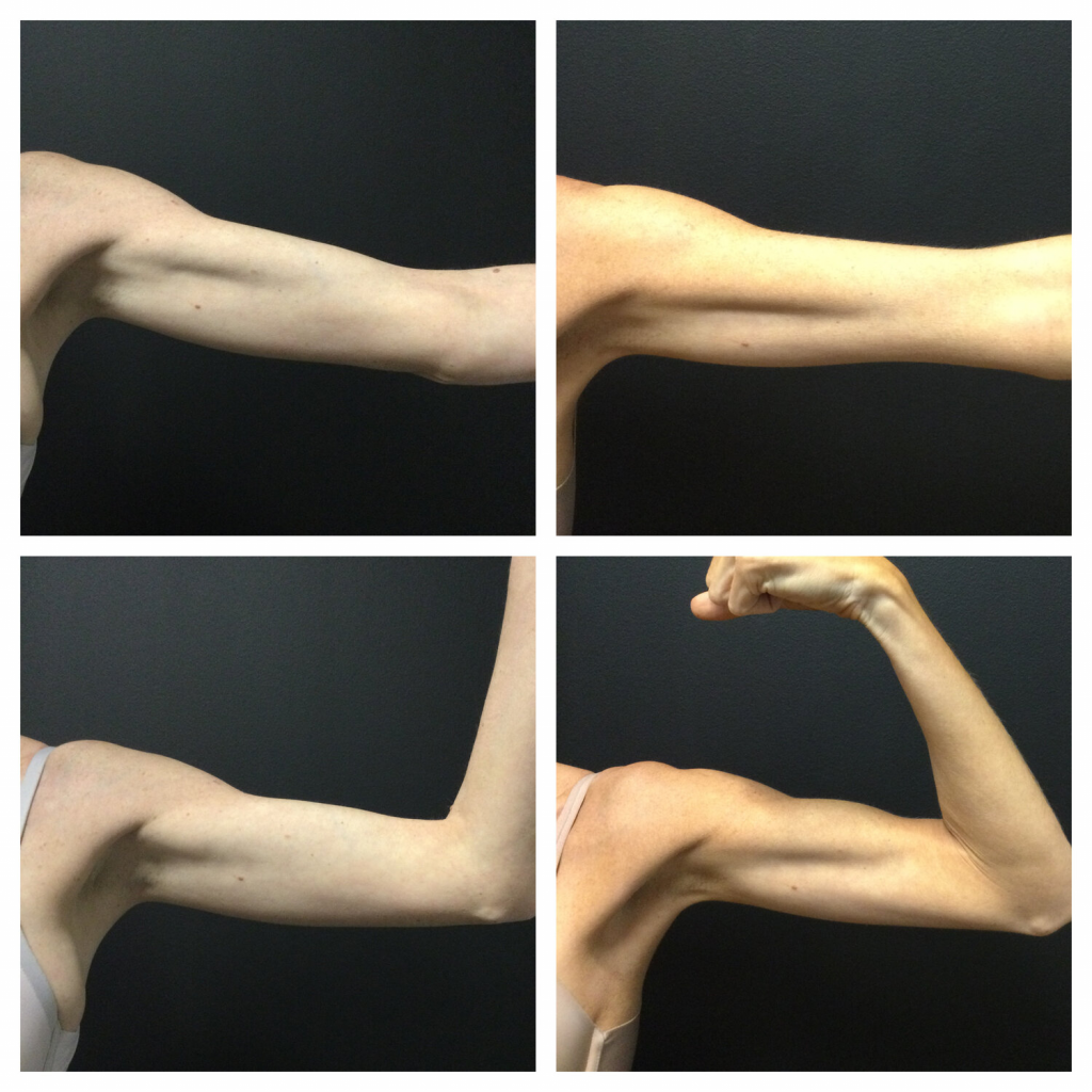 Arm muscles before and after the procedure