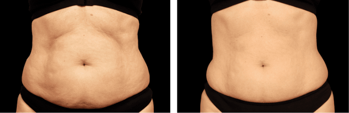 The result of using the Emsculpt device on the abdomen