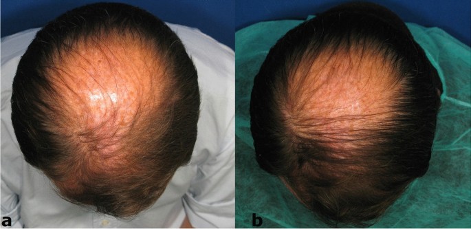 The result of using red light therapy for hair growth in men