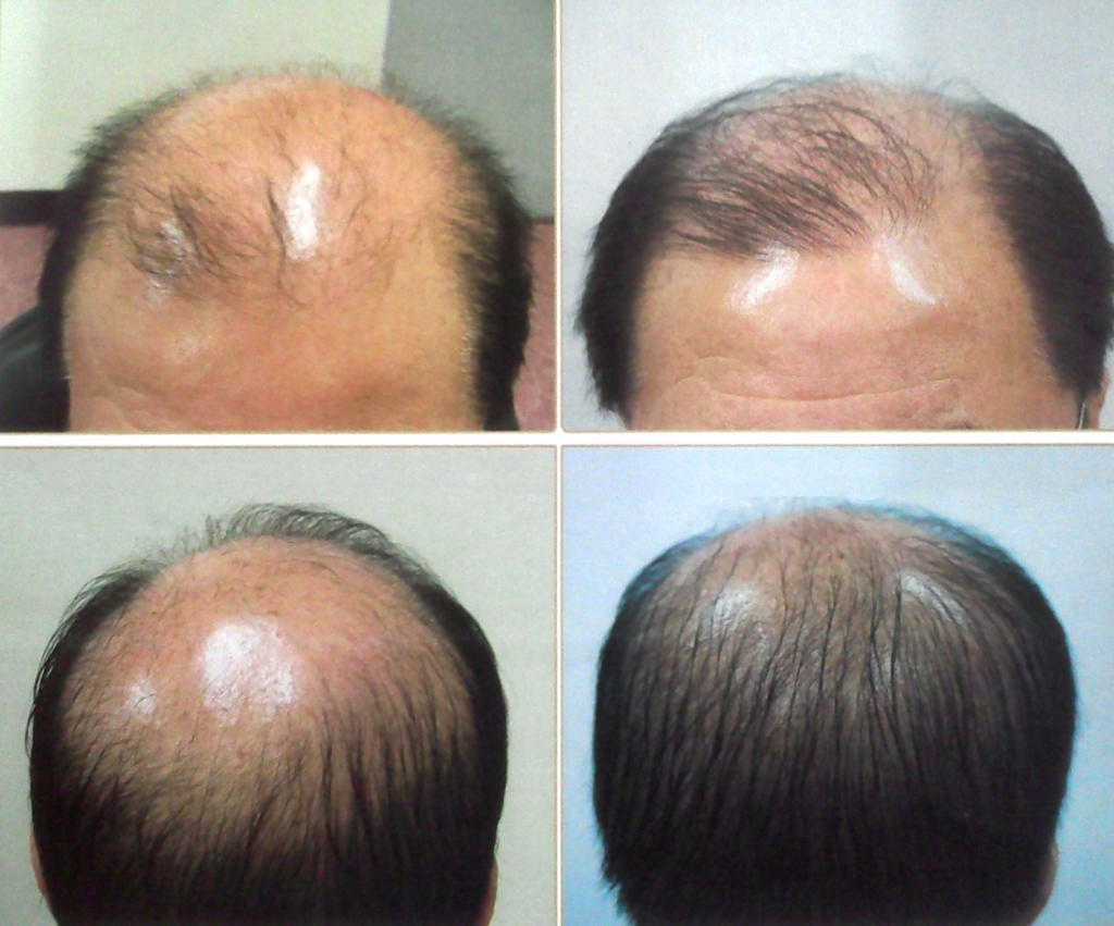 laser light therapy for hair loss