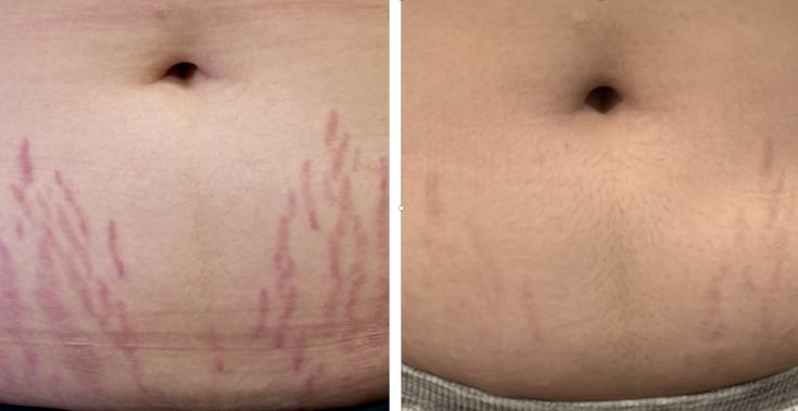 Before and after Pulsed Dye stretch mark laser removal