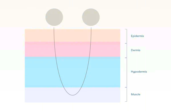 Microcurrent from the NuFace Mini stimulates the muscle level under the skin. Resource: NuFace