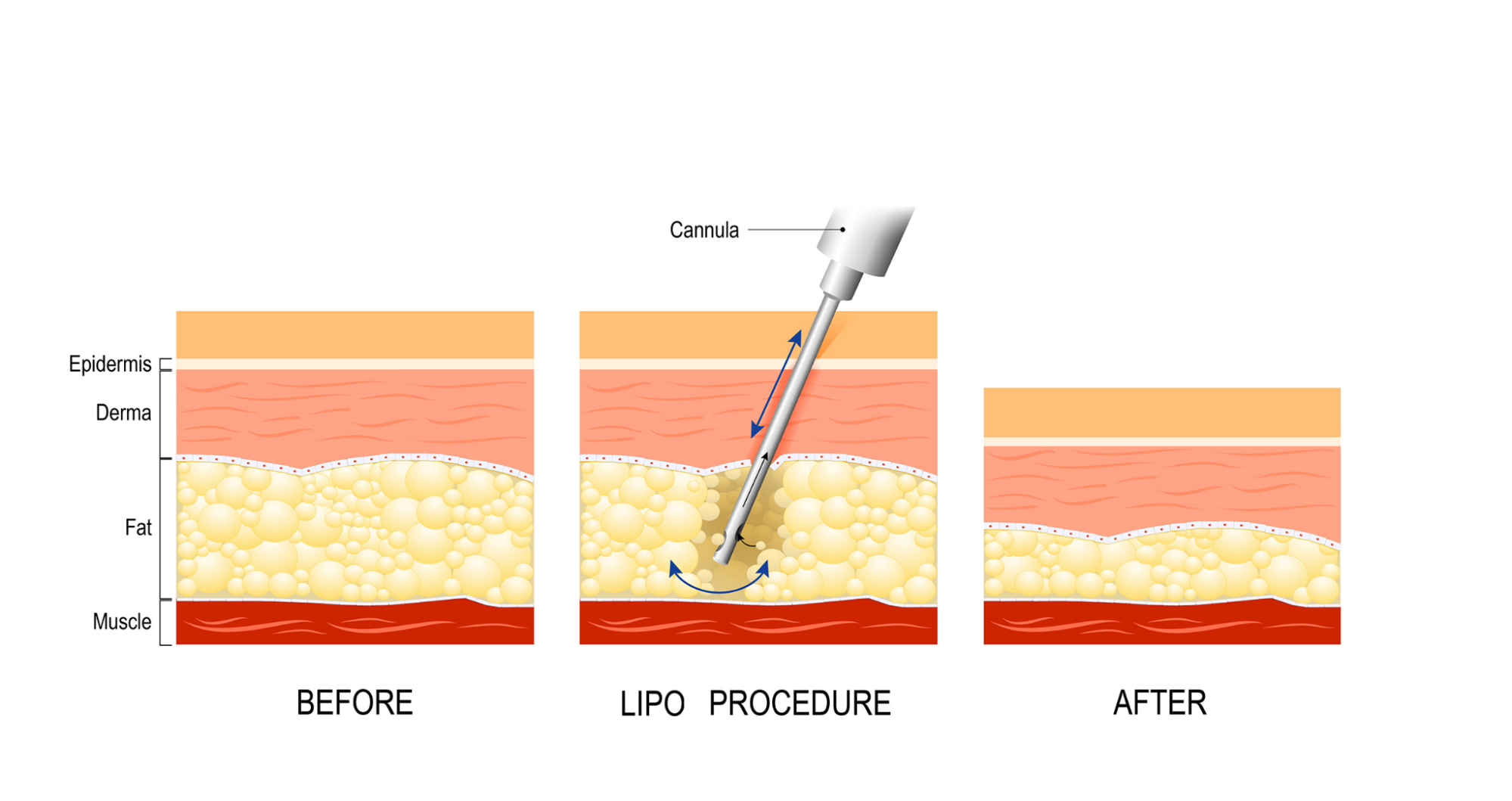 Laser lipo procedure