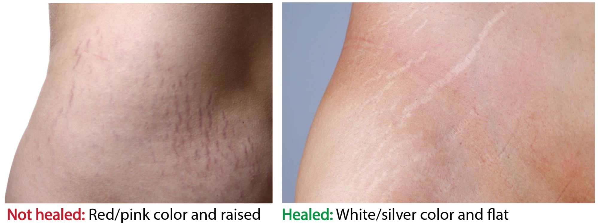 The difference between fresh and healed stretch marks